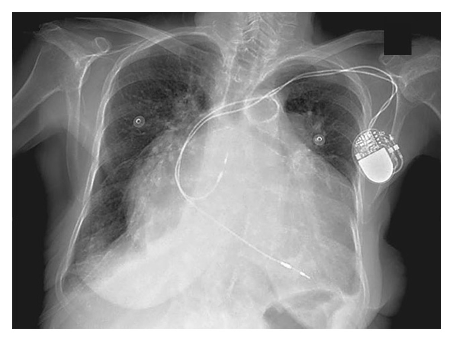 Left atrium