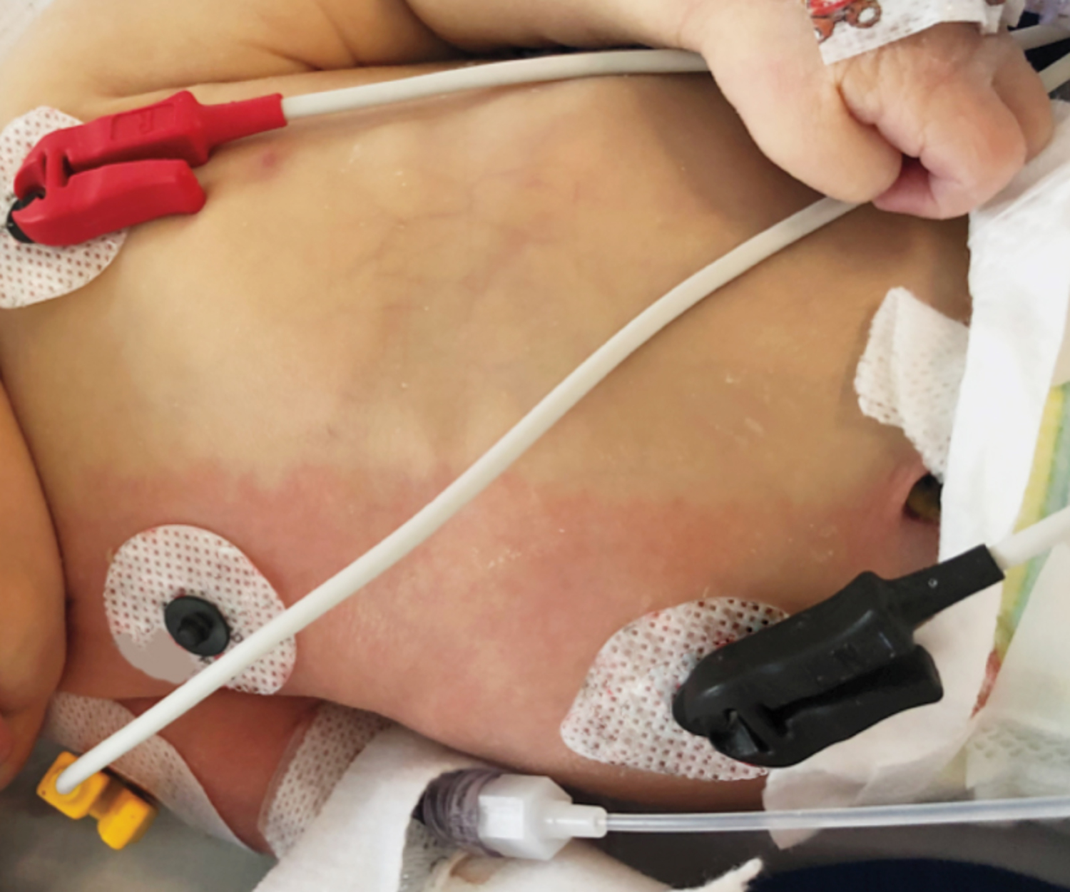 Infant harlequin syndrome
