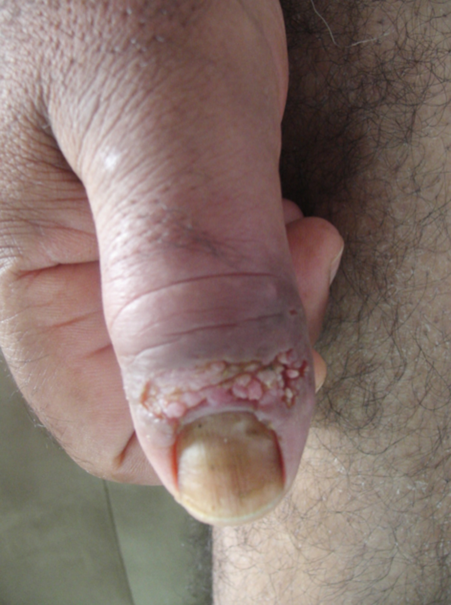 Cutaneous leishmaniasis