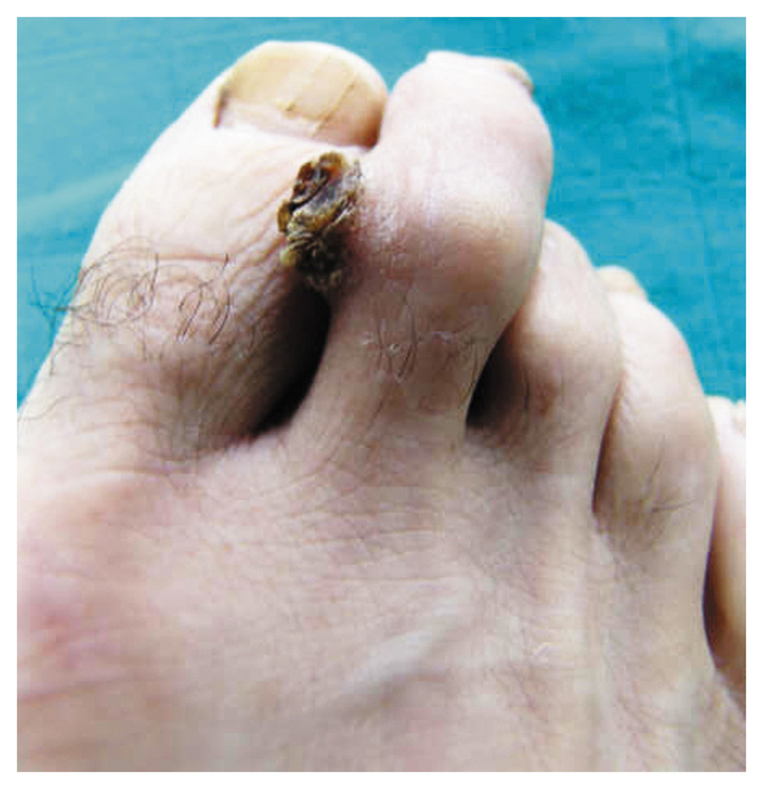 Keratoacanthoma