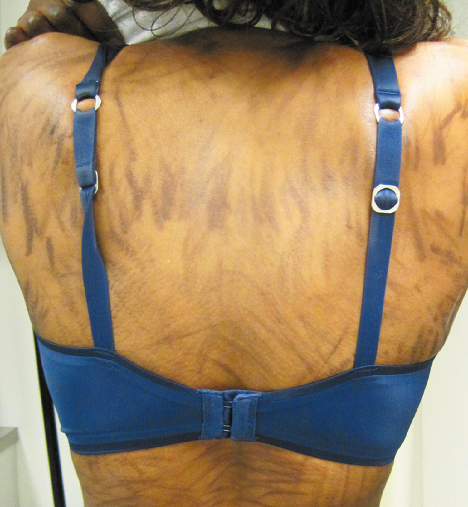 Treatment with bleomycin