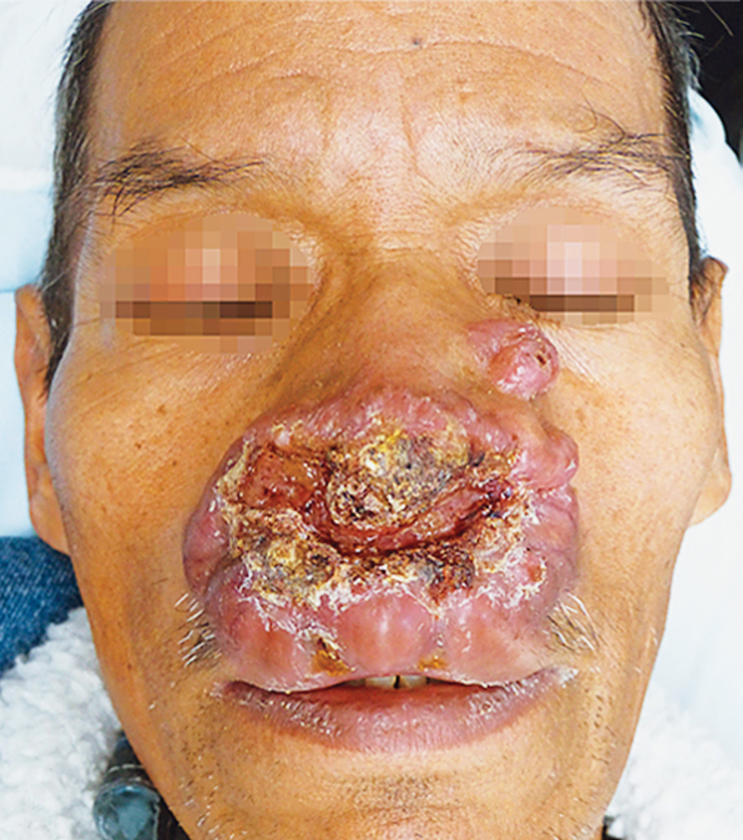 Klebsiella rhinoscleromatis