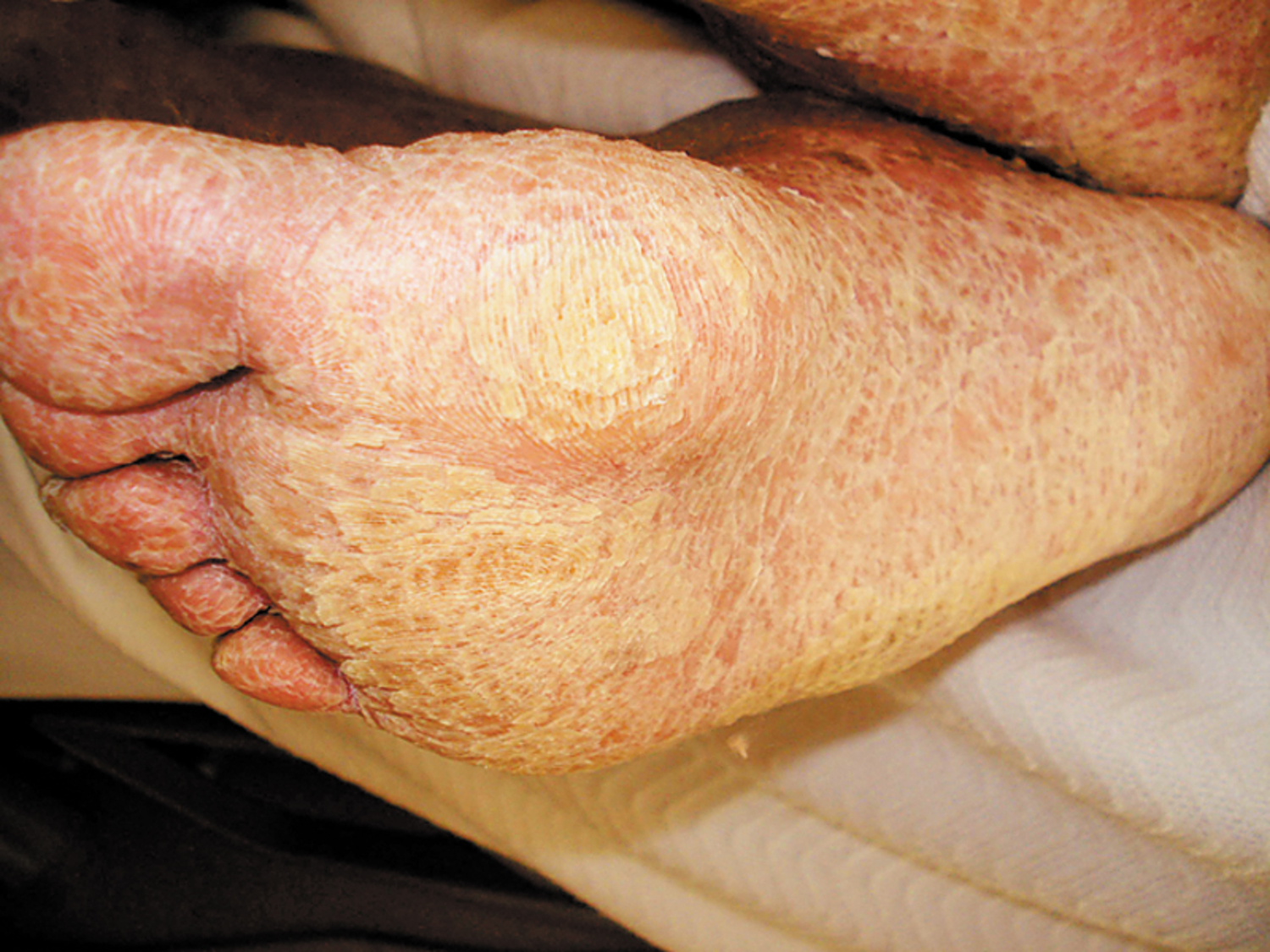 Keratoderma