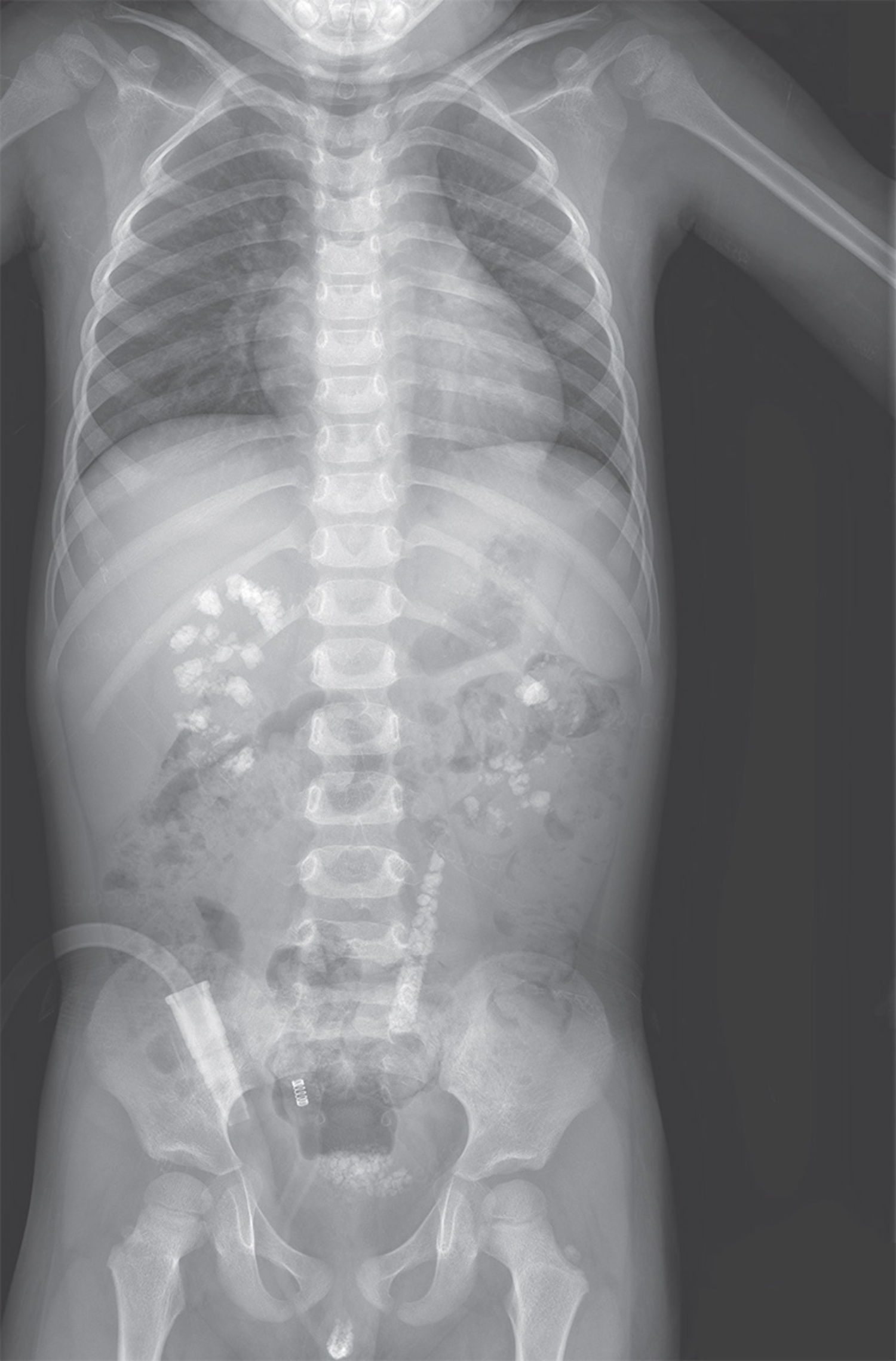 Primary hyperoxaluria