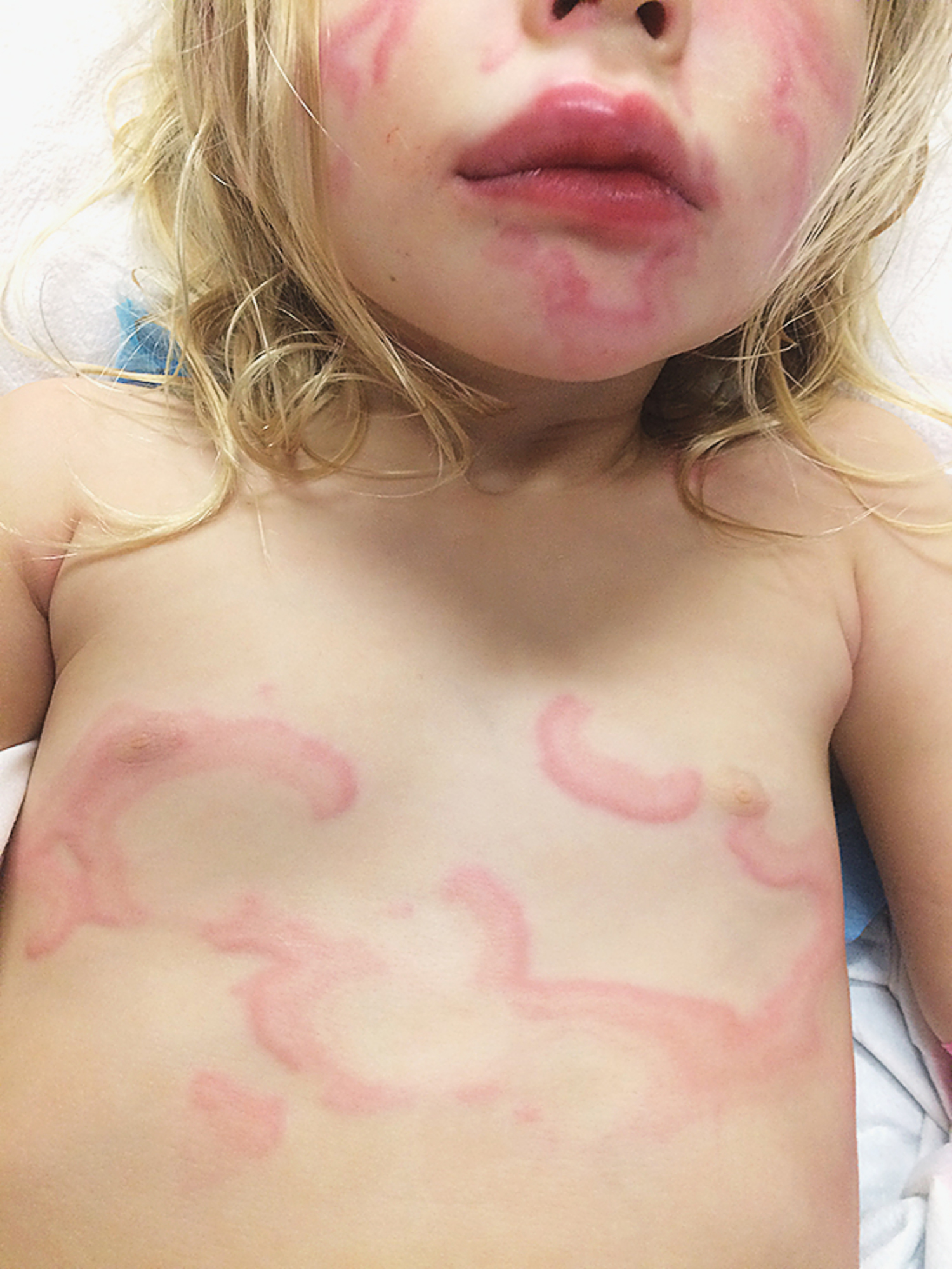 Urticaria multiforme