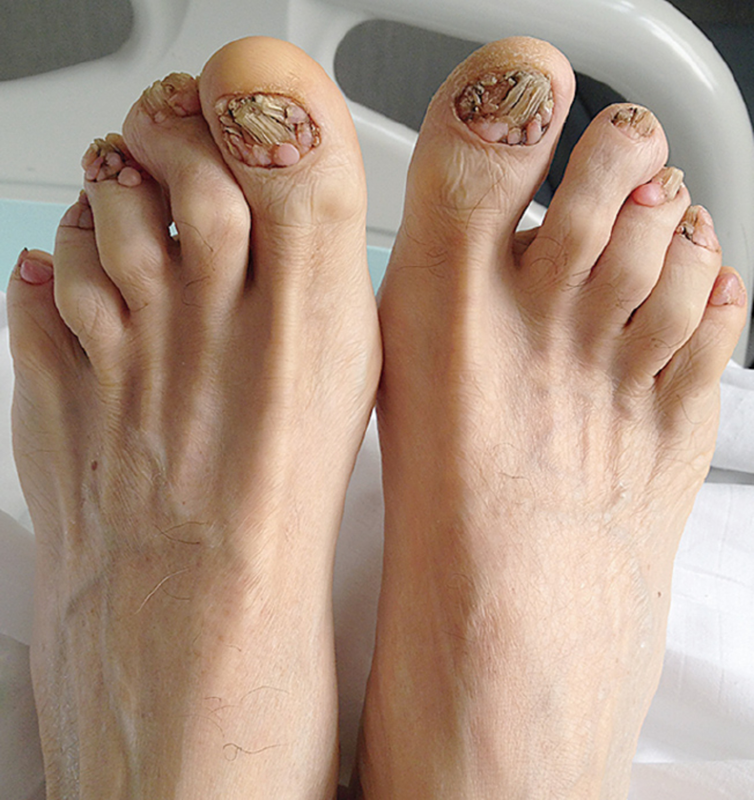 Periungual fibroma