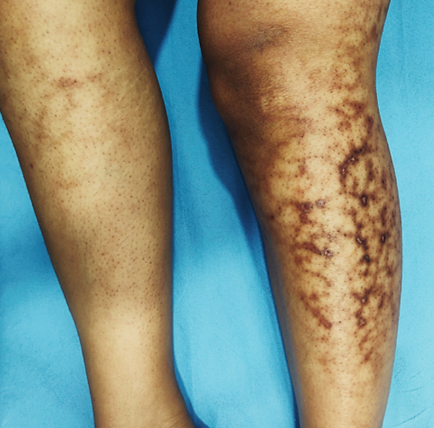 Erythema ab igne