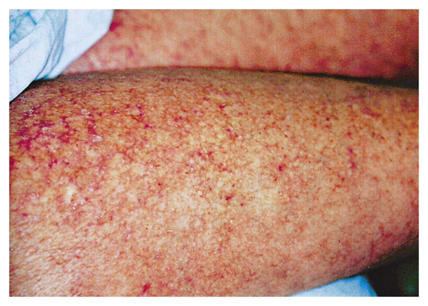 Graft-versus-host disease