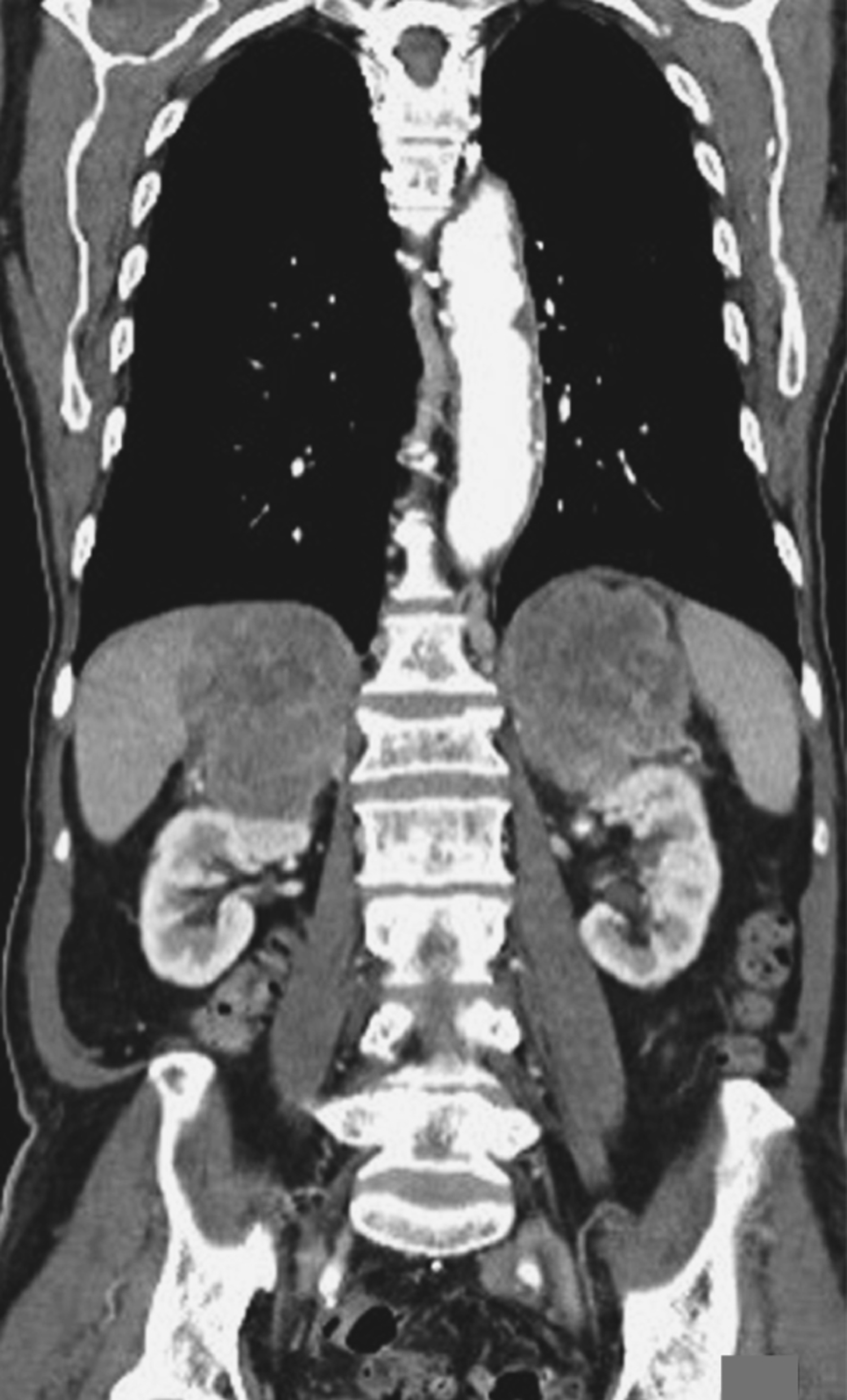 Primary adrenal lymphoma