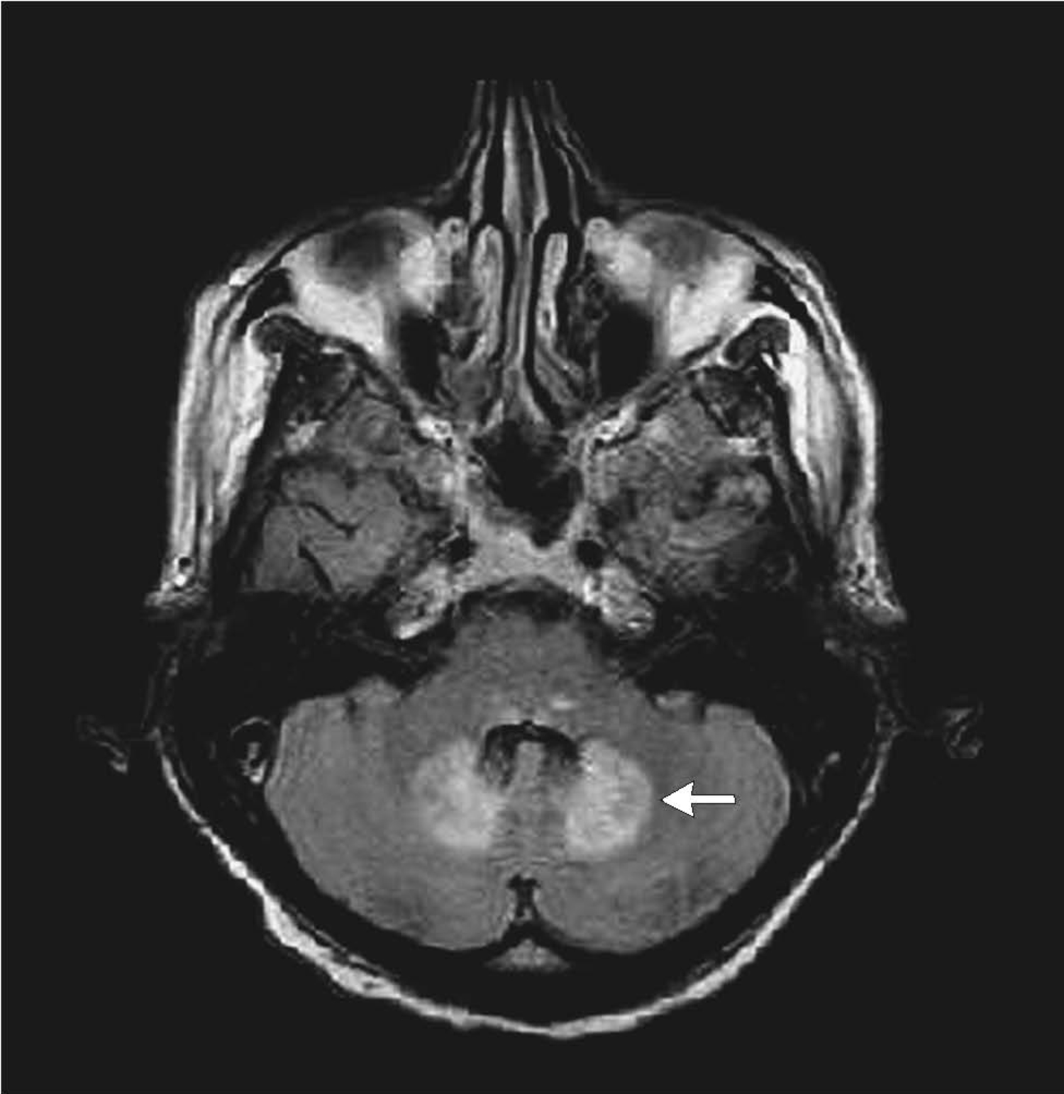 Metronidazole-associated encephalopathy