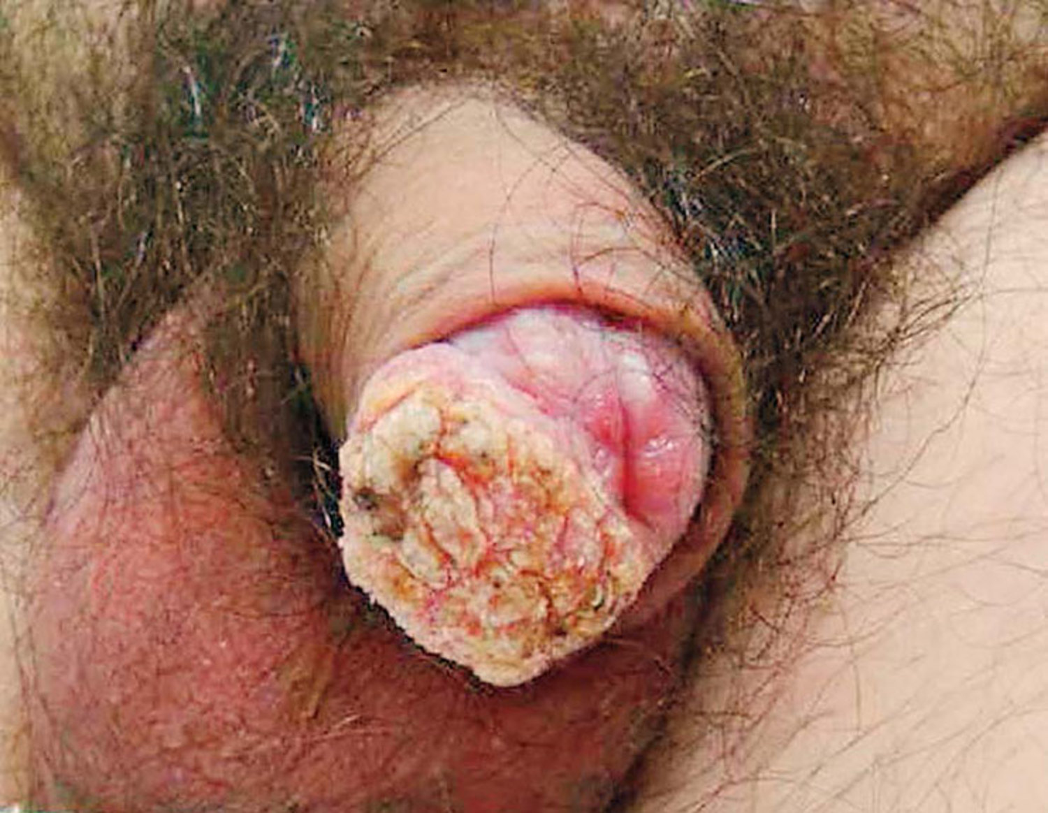 Squamous-cell carcinoma