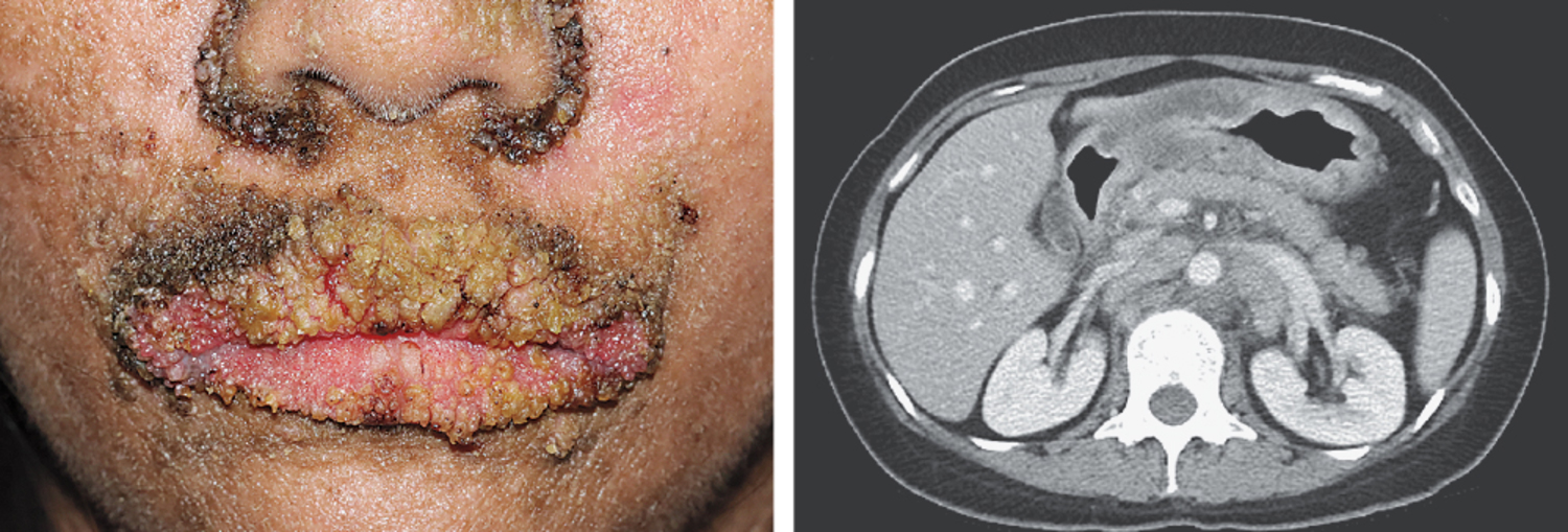 Malignant acanthosis nigricans