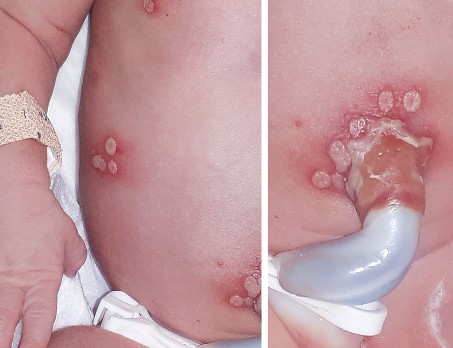 Neonatal herpes simplex virus