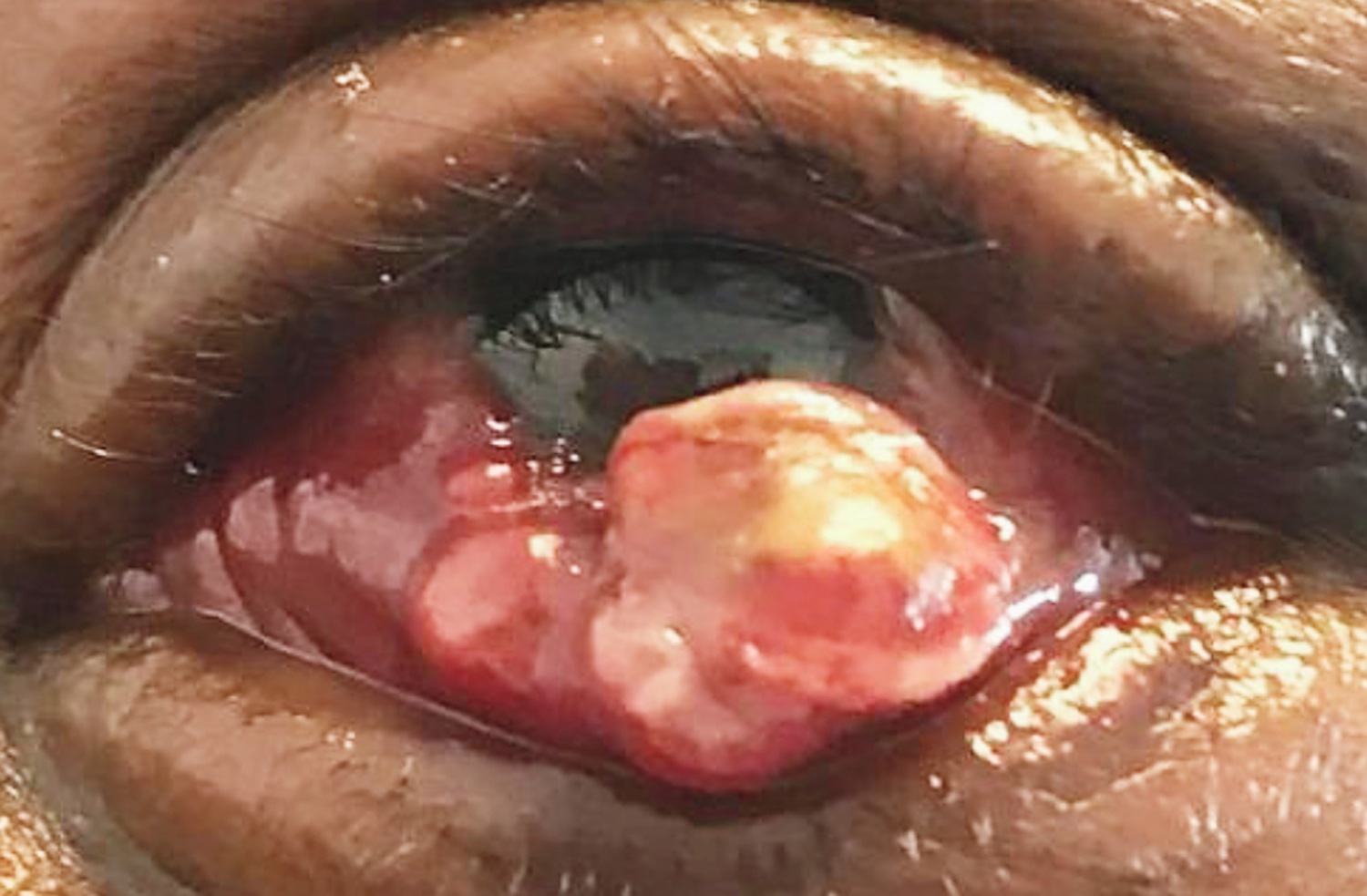 Kaposi's sarcoma