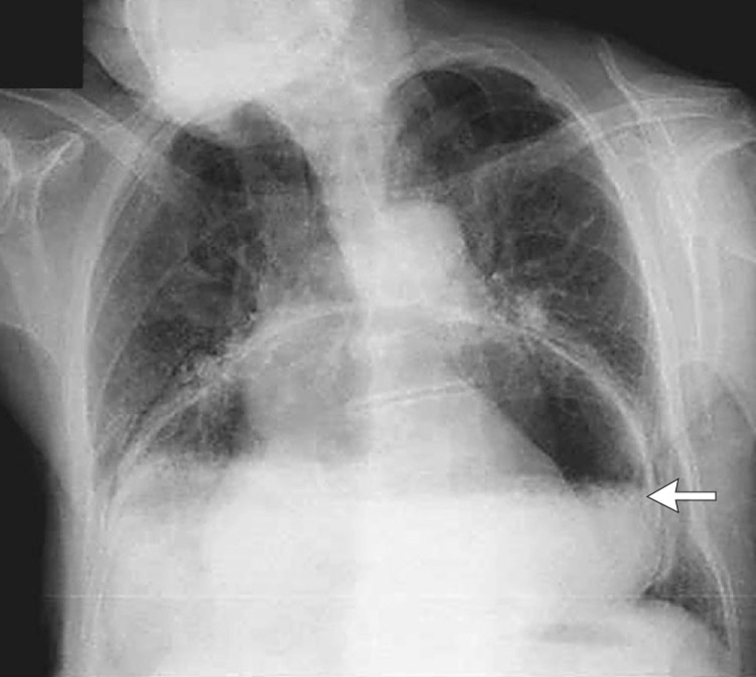 Paraesophageal hernia