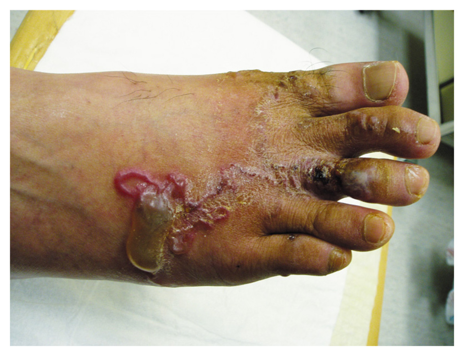 Cutaneous larva migrans