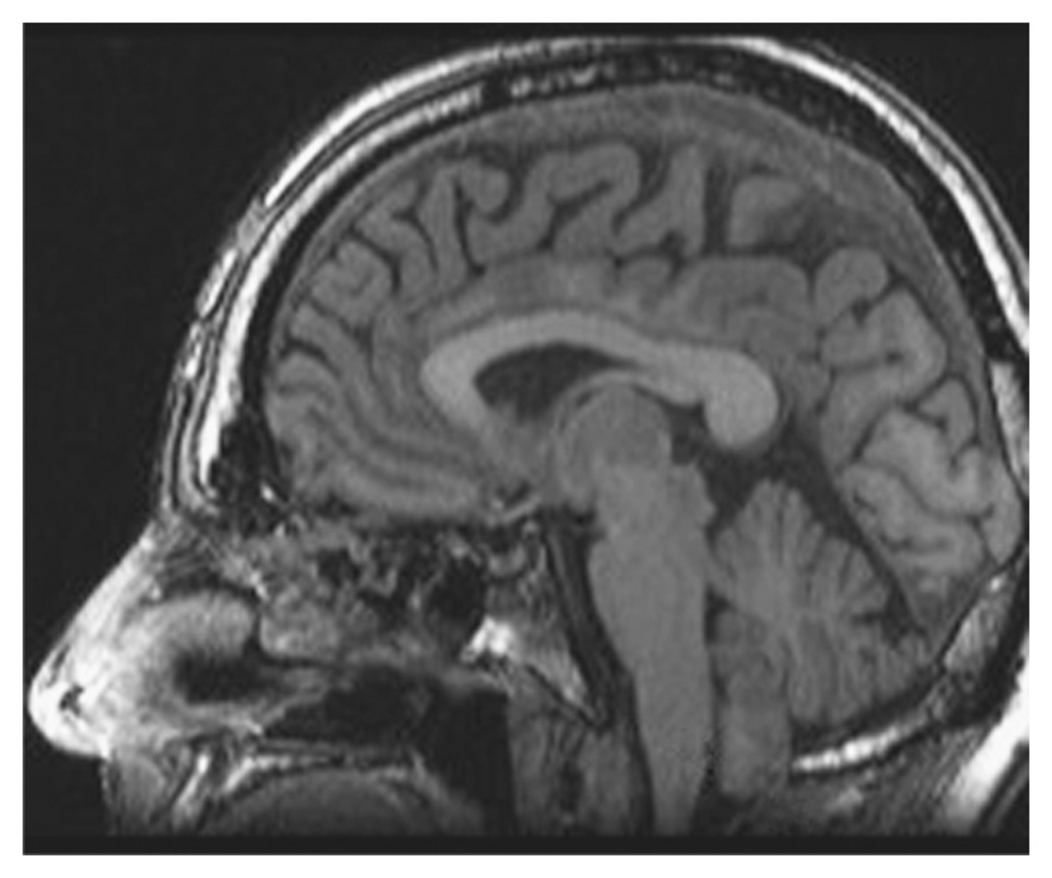 Chiari I malformation