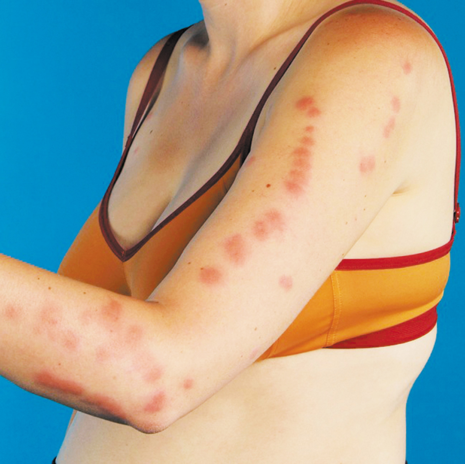 Bedbug bites