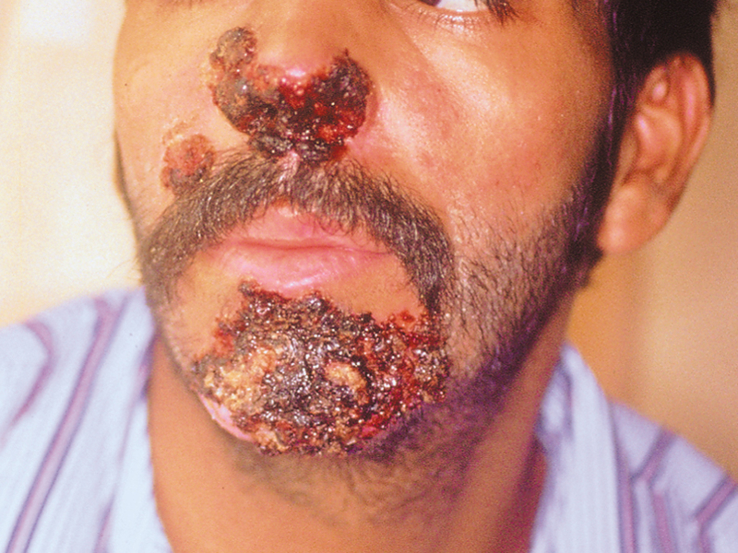 Herpes simplex virus infection