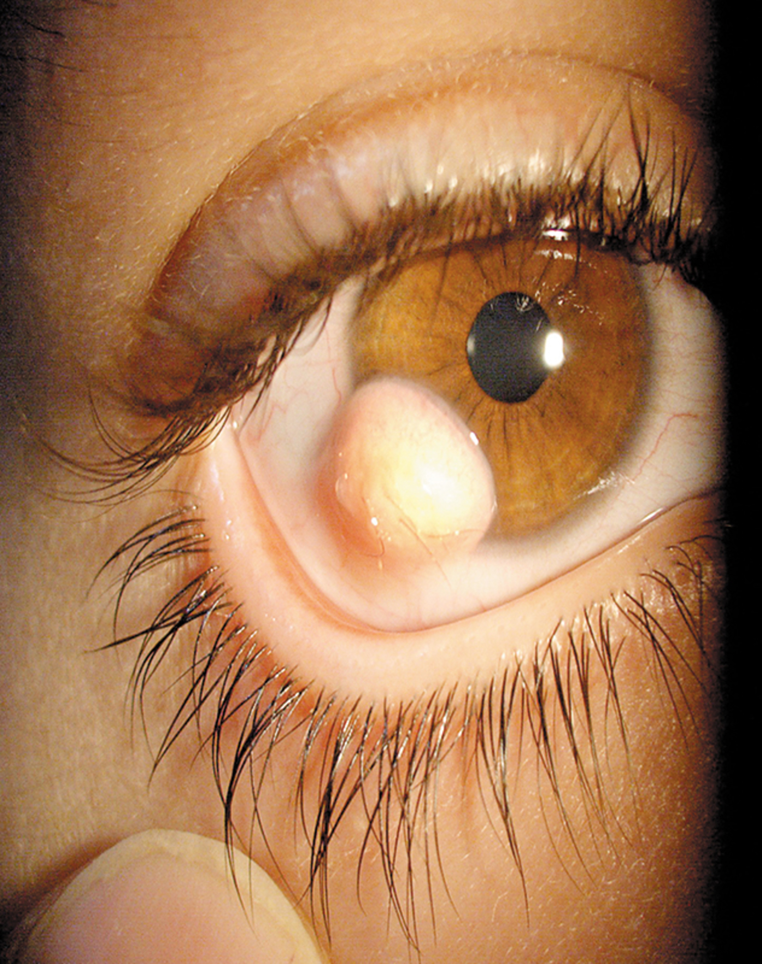 Dermoid