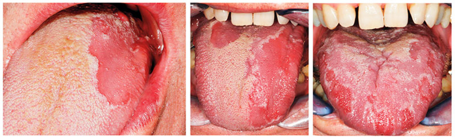 Geographic tongue