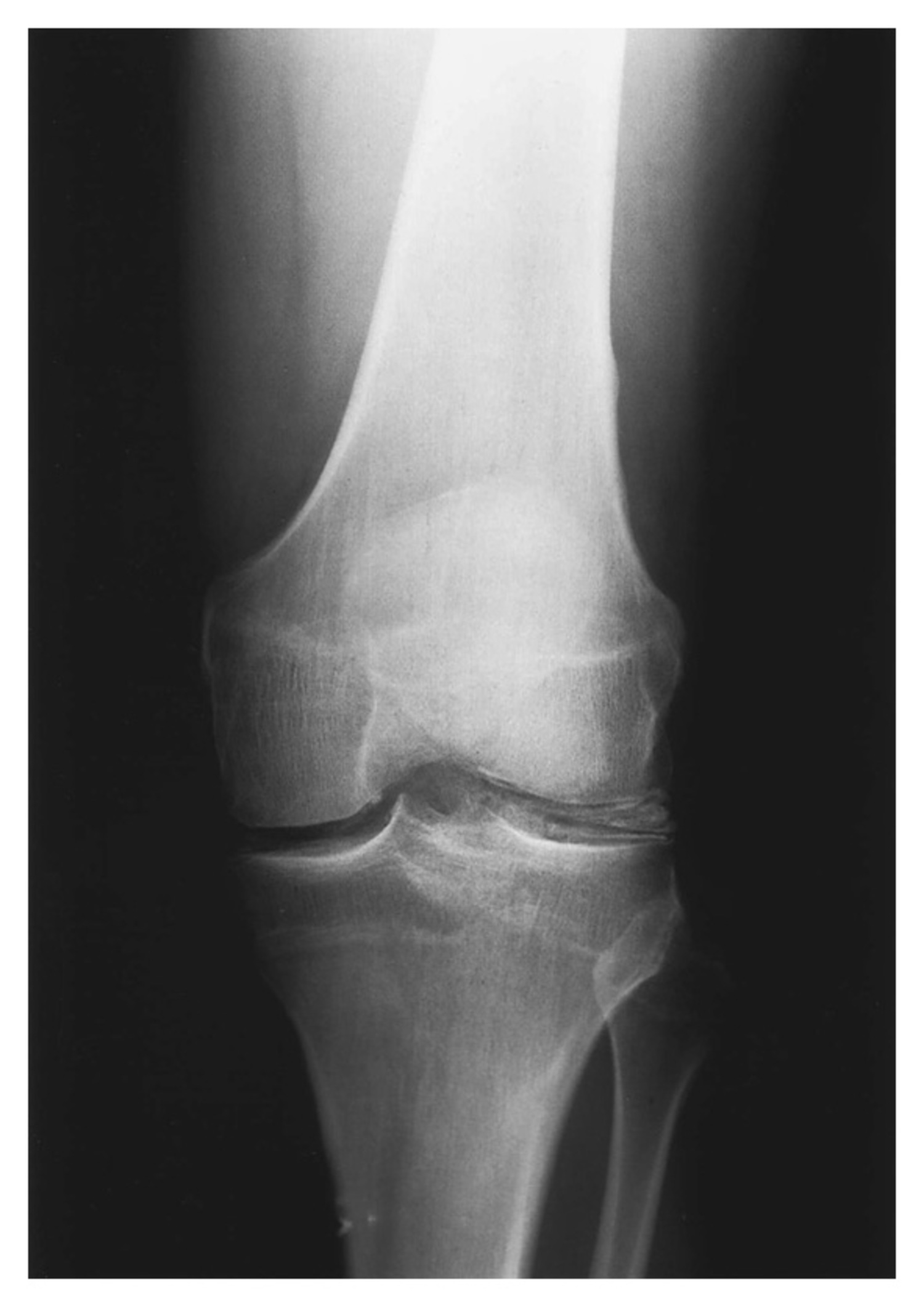 Chondrocalcinosis