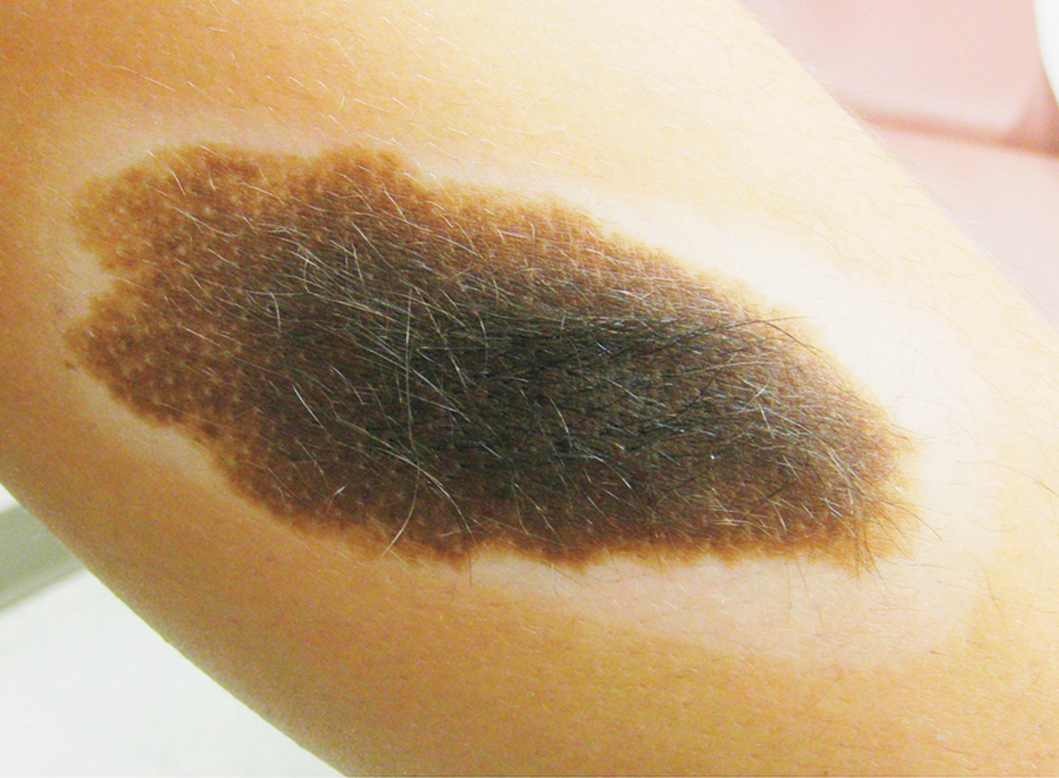 Halo nevus
