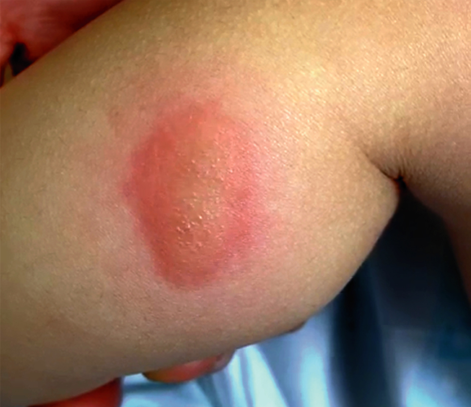 Insect bite