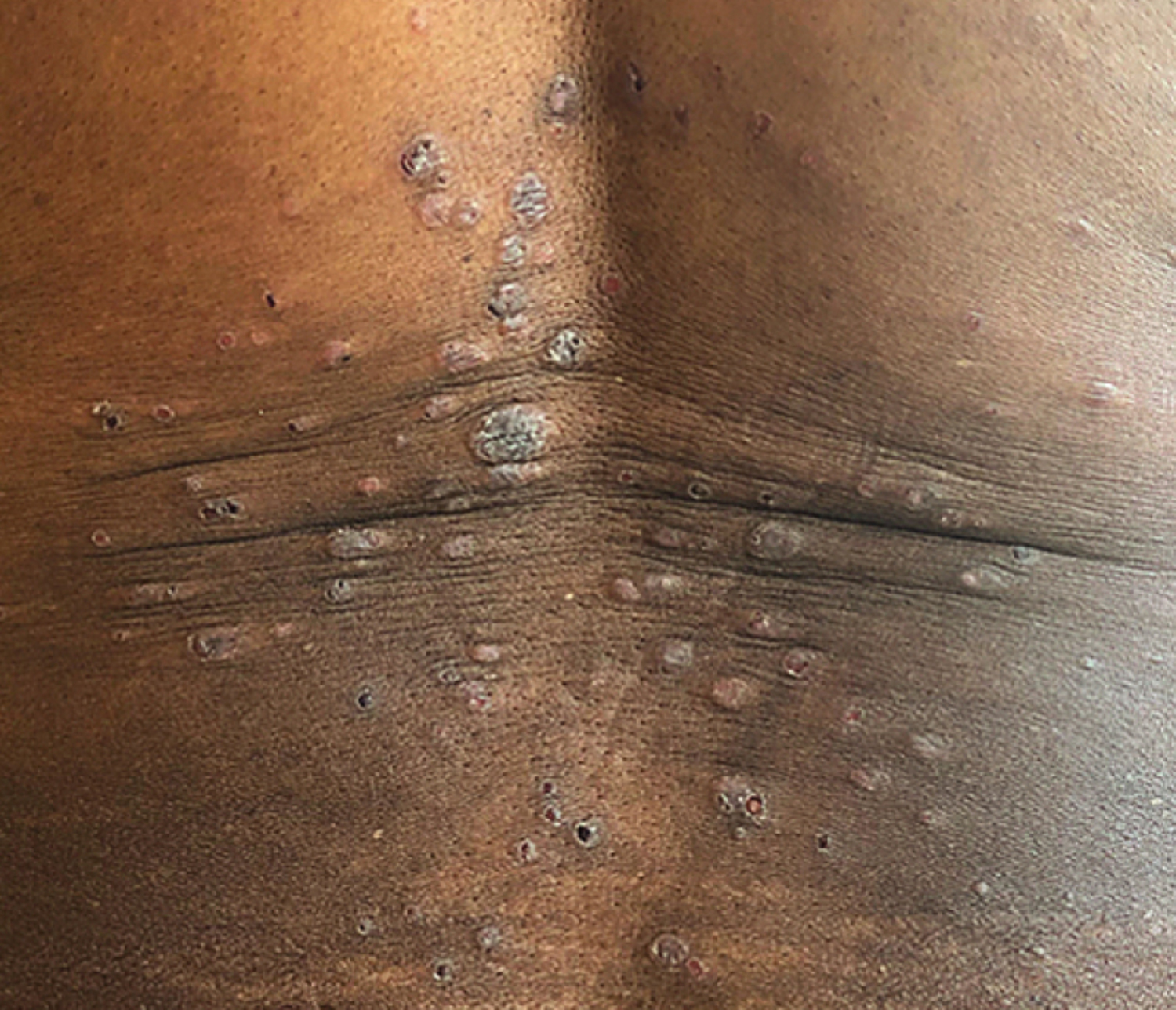 Tinea