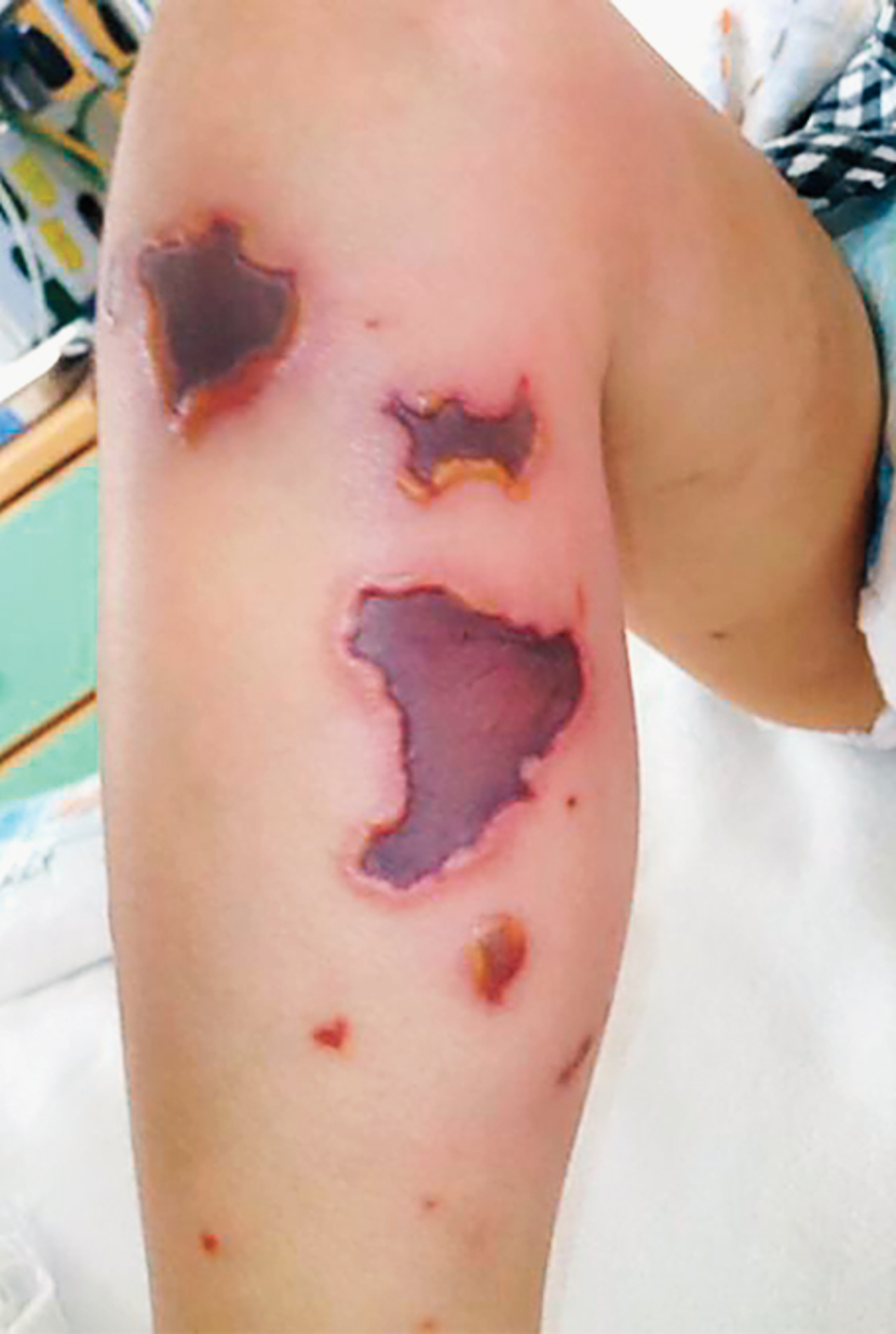 Purpura fulminans