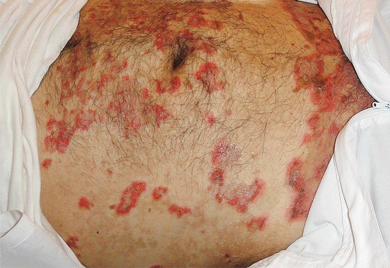 Necrolytic migratory erythema