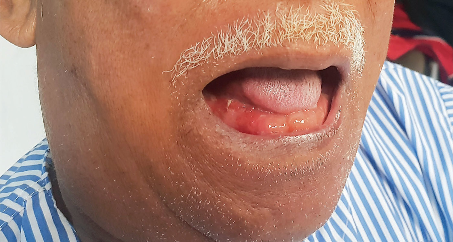 Ludwig's angina