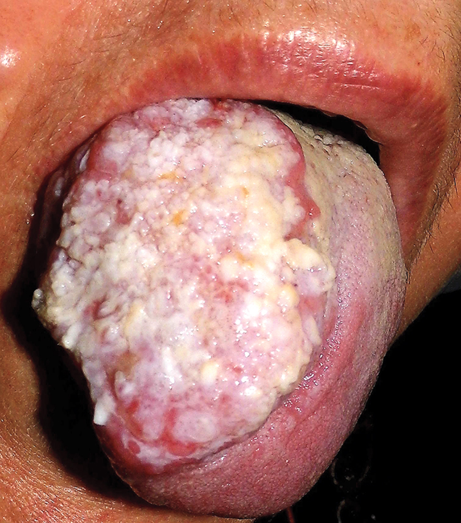 Verrucous carcinoma