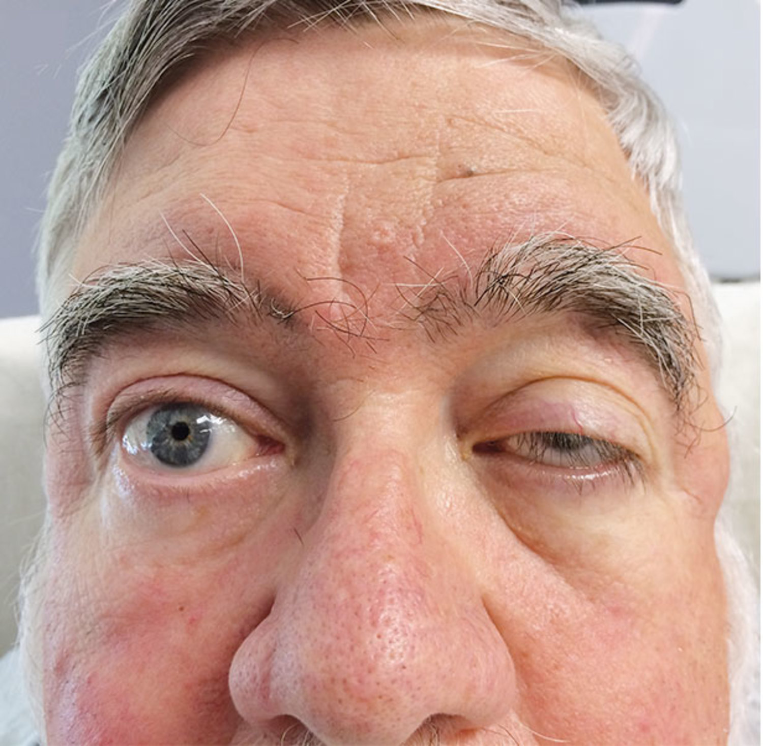Myasthenia gravis