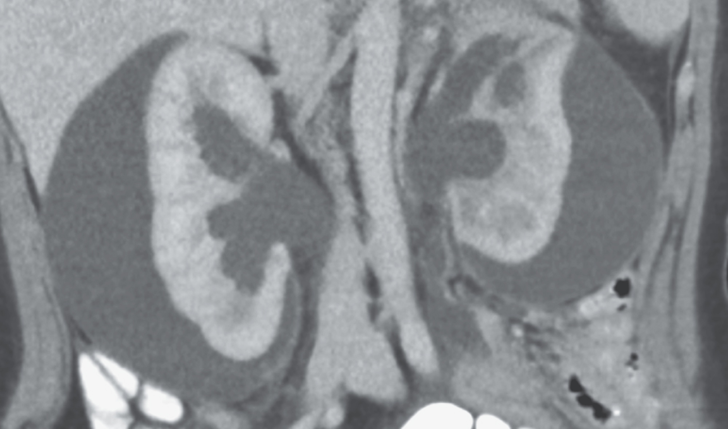 Page kidney