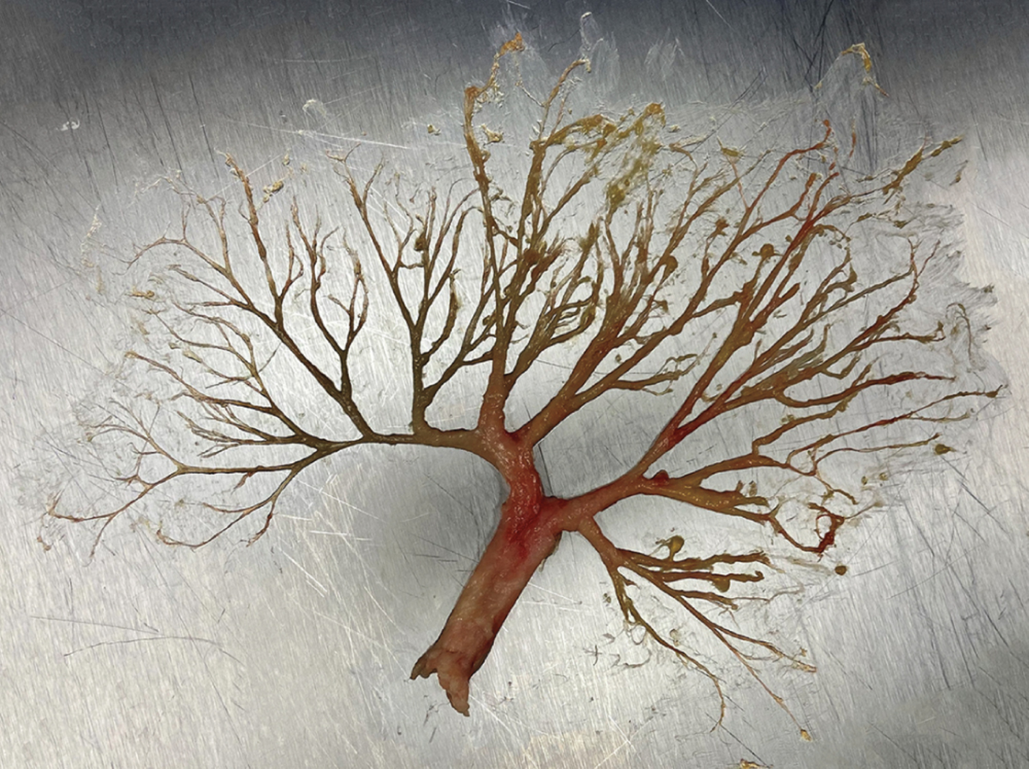 Plastic bronchitis