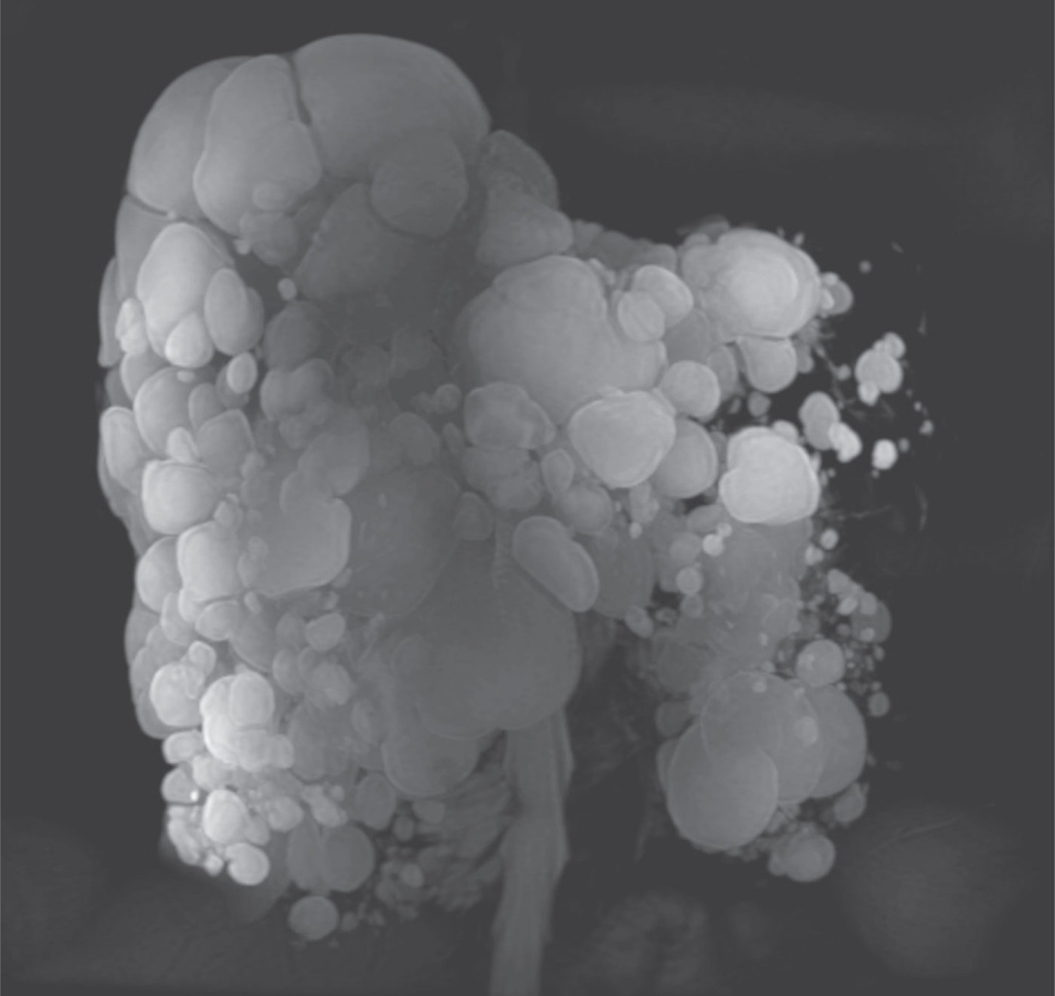 Autosomal dominant polycystic kidney disease