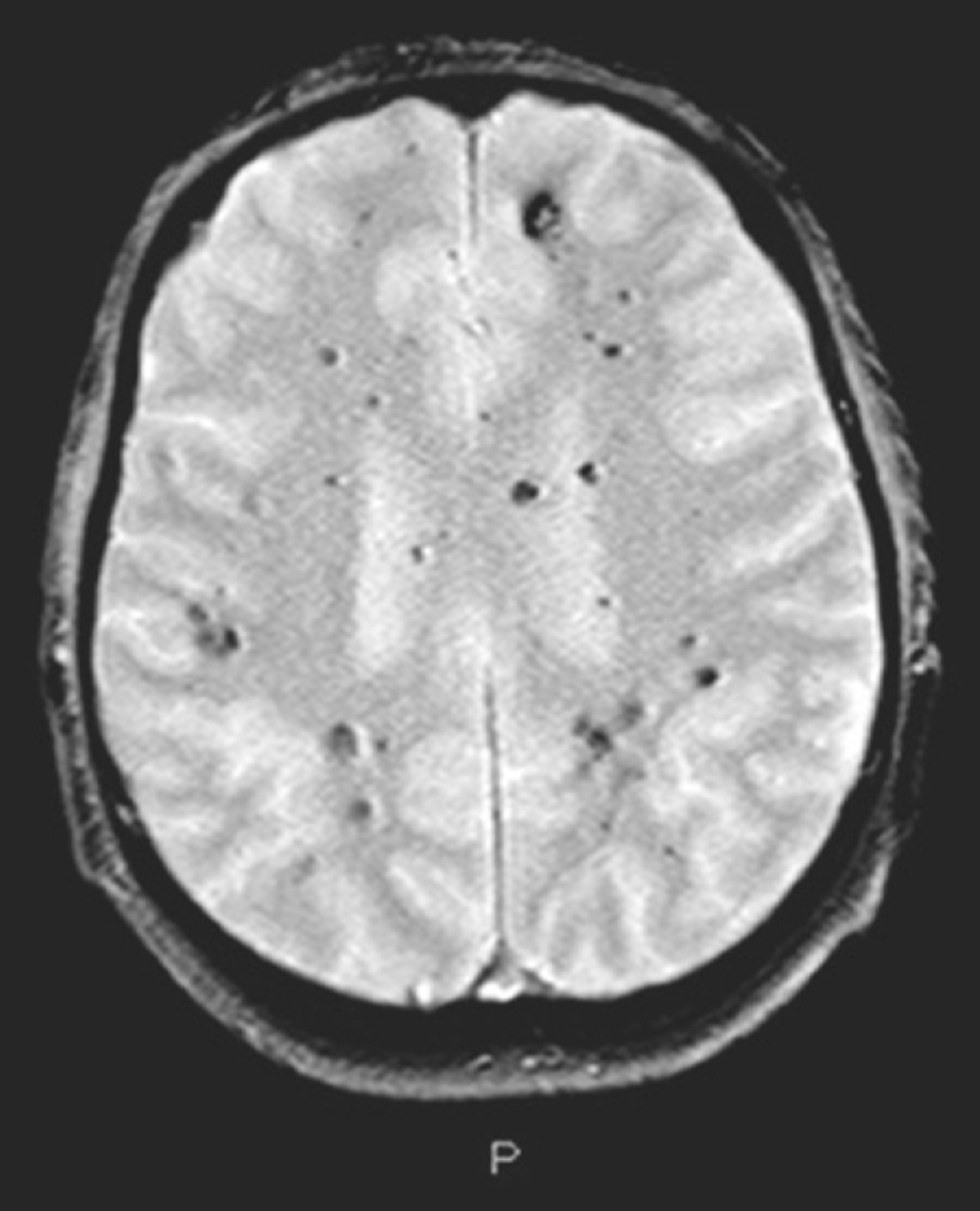 Cerebral cavernous malformations