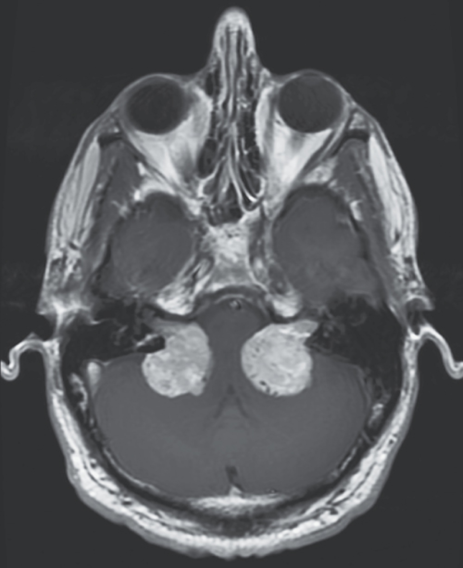 Neurofibromatosis type 2