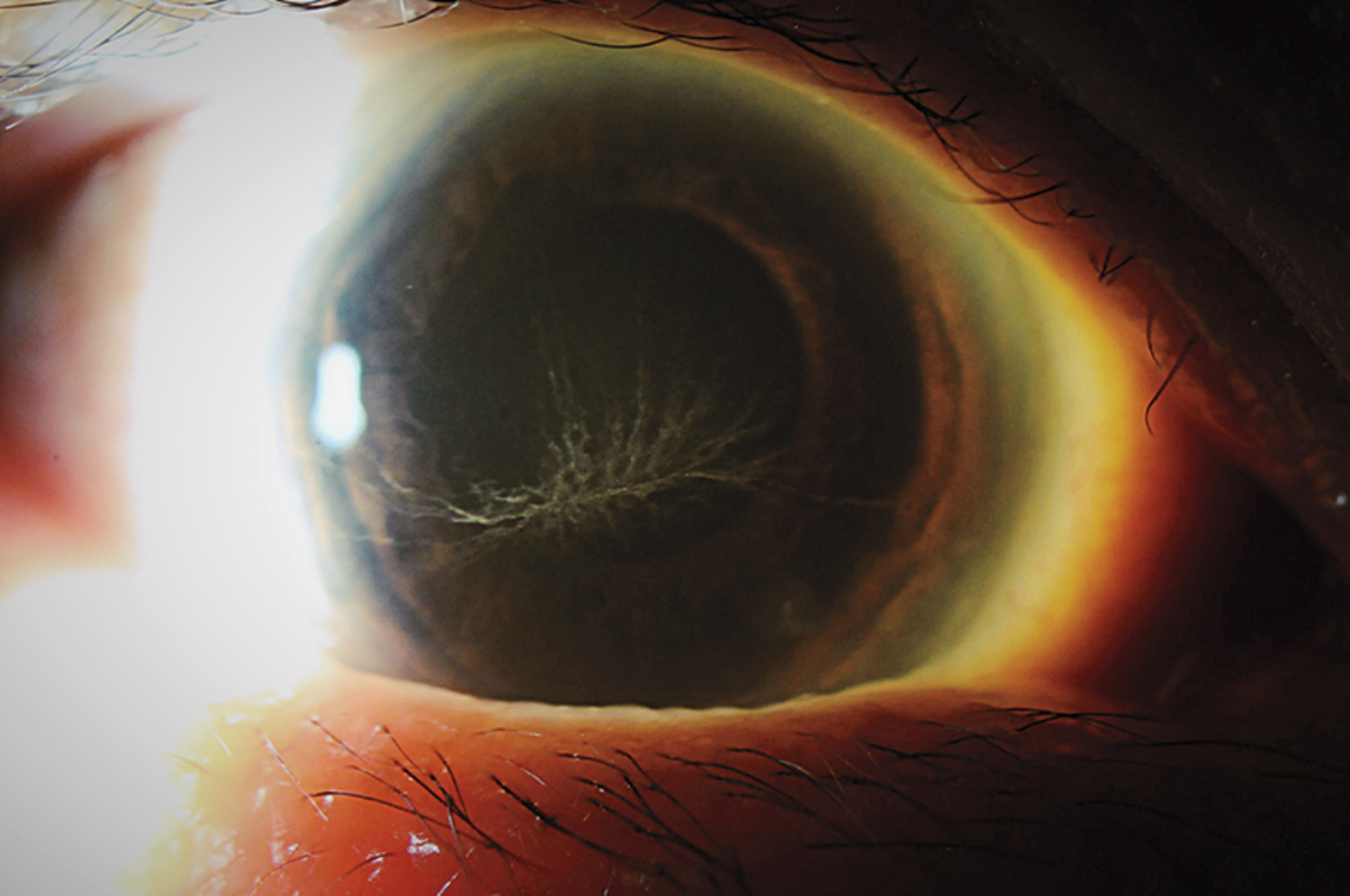 Amiodarone-induced vortex keratopathy