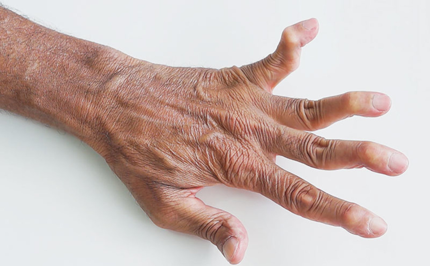 Jaccoud's arthropathy