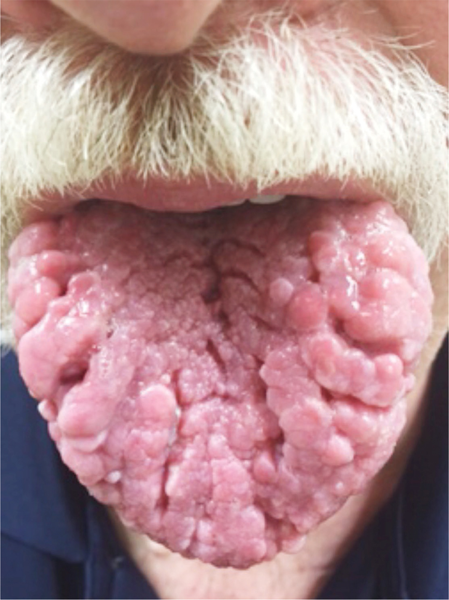 Cowden syndrome
