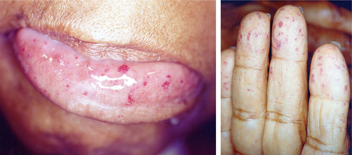 Hereditary hemorrhagic telangiectasia