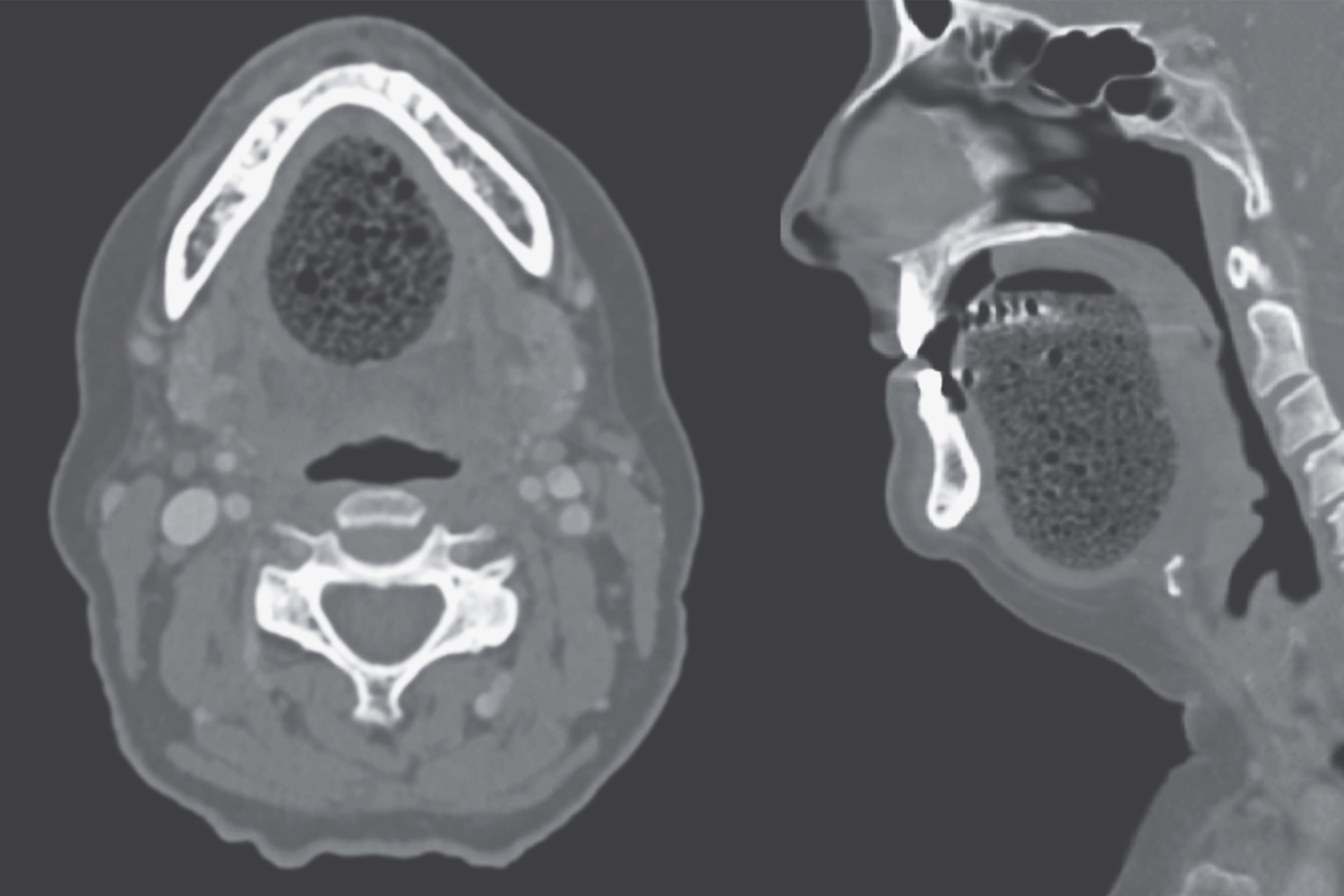 Sublingual epidermoid cyst