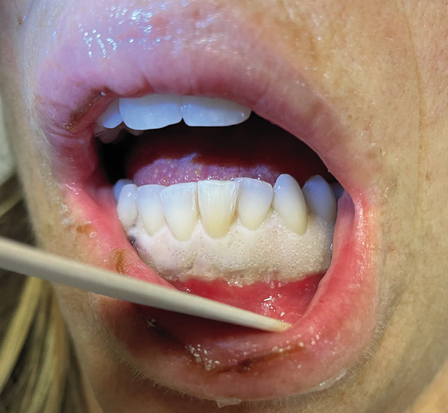 Leukemic infiltration of the gingiva