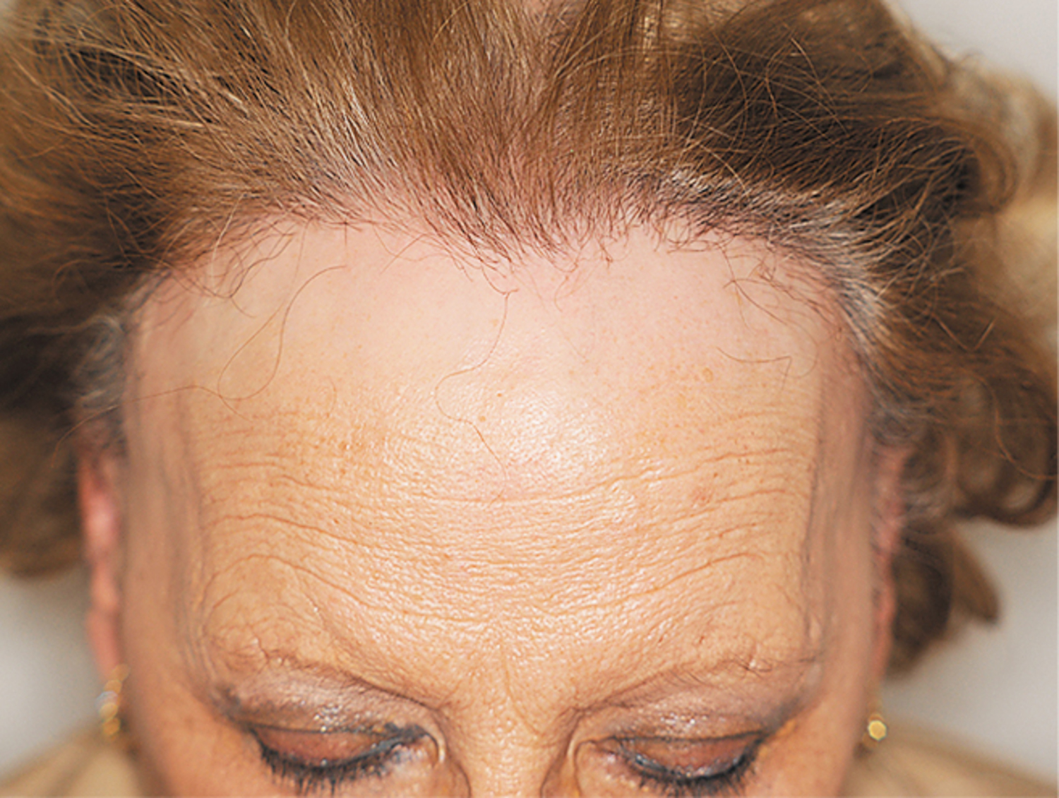 Fibrosing alopecia