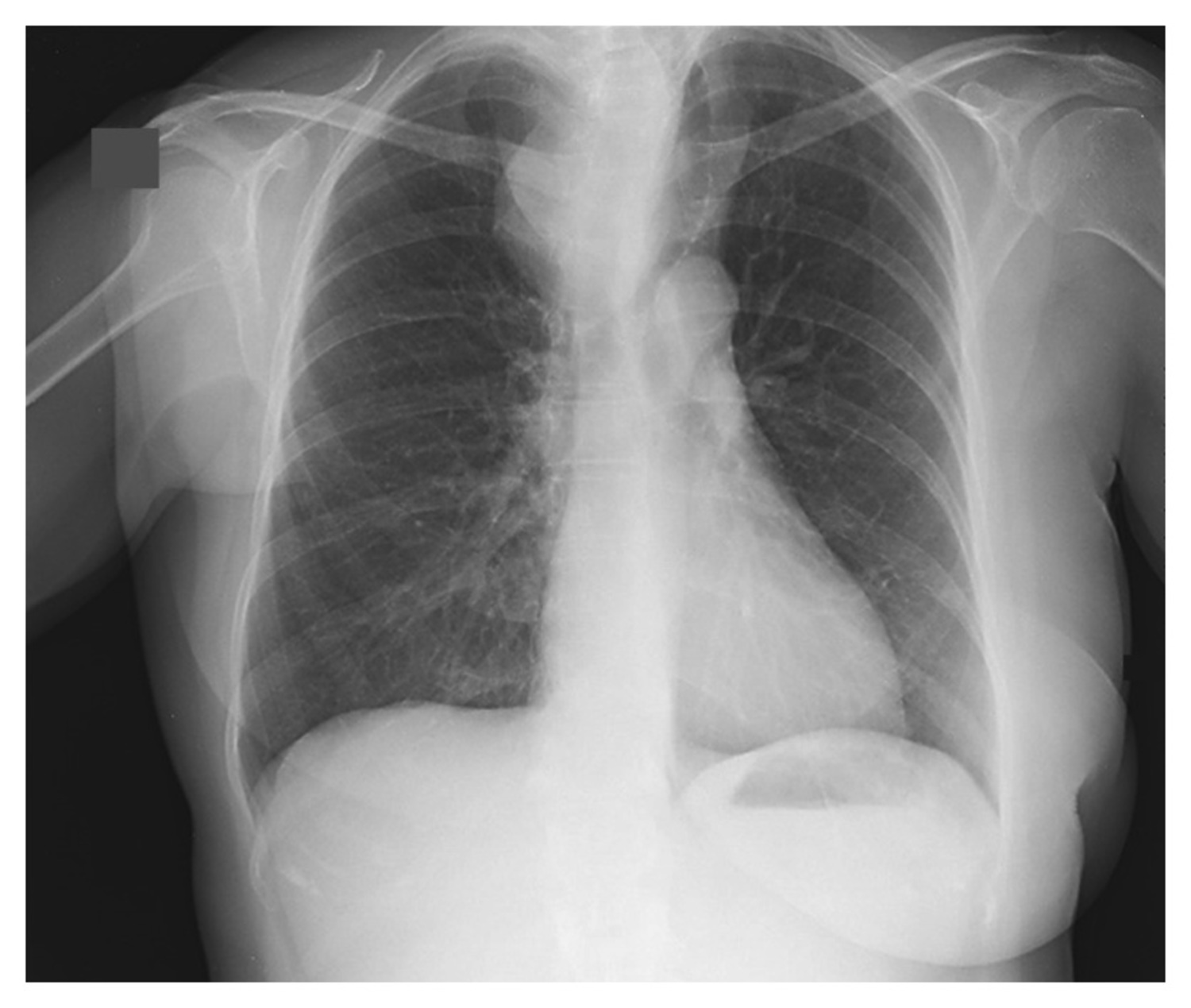 Substernal goiter