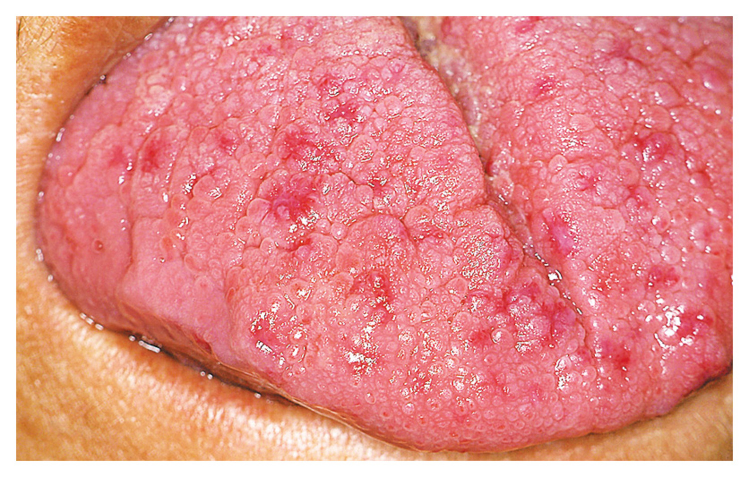 Hereditary hemorrhagic telangiectasia