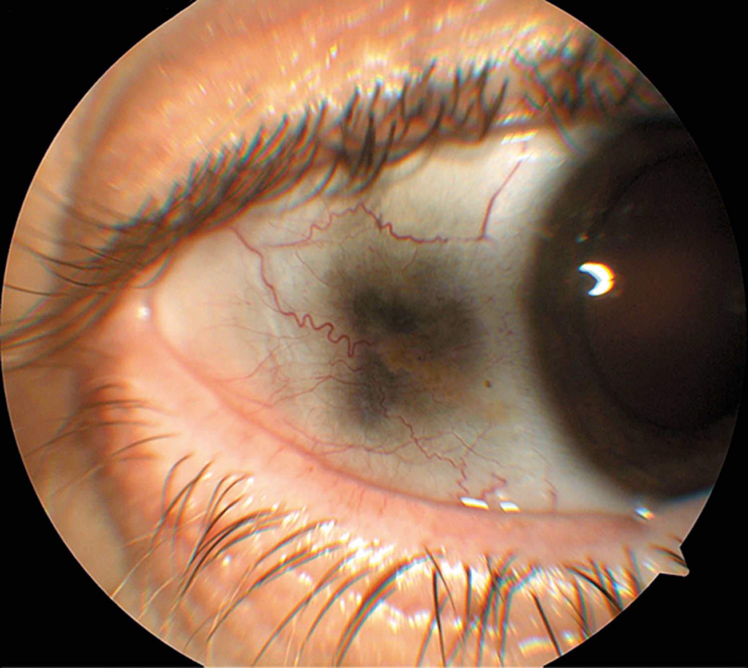 Ochronosis