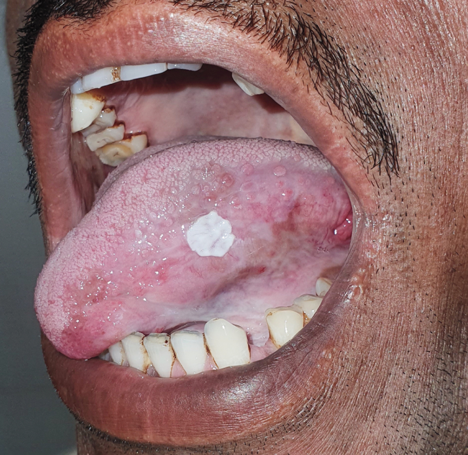 Leukoplakia